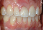 Figure 1 View showing generalized recession at upper anterior teeth and advanced bone loss and recession at lower left central incisor. Upper right central incisor had a hopeless prognosis.