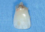 Figure 4 Tooth extracted with internal resorption.