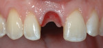 Figure 7 Bonded tooth removed. The tissue height was maintained with the properly contoured modified tooth acting as a provisional restoration.