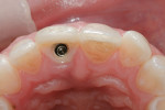Figure 9 Incisal view showing implant position and contours of the provisional restoration. Screw access was slightly buccal in case a traditional screw-retained crown was to be designed.