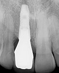 Figure 15 Radiograph of final restoration. (implant placed by periodontist David Barack, DDS)