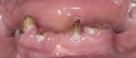Figure 17 Lower anterior teeth with hopeless prognosis.