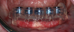 Figure 18 Computer-generated guide aiding the location of lower implants without interference of the mandibular nerve.
