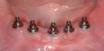 Figure 19 Healed implants with abutments in place showing excellent spacing among the implants. (implants placed by oral surgeon Mark J. Steinberg, DDS, MD)