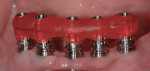 Figure 20 Clinical verification of the laboratory-fabricated index. Only one or two screws are used during the test.