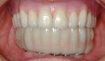 Figure 21 Try-in of the lower provisional against the wax try-in upper denture.