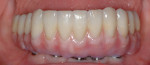 Figure 24 Final prosthesis with open gingival embrasures to facilitate patient oral hygiene. (prosthesis fabricated by Henning Visser, MDT)