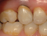 Figure 3A and Figure 3B The titanium abutment with all- ceramic crown restoration. Note that the tissue color appears gray at the gingival margin.