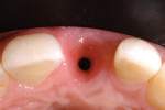Occlusal view of the mature tissue site 3 months after provisional screw-retained implant was placed.
