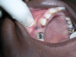 A misplaced implant demonstrates the difficulties of successful implant placement in the esthetic zone.