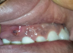 Peri-implantitis with buccal sinus tract.