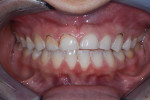 Esthetic crown lengthening was accomplished using a diode laser. The needs were minimal because the patient did not show a great deal of maxillary gingiva. It was determined that most length would be restored incisally, not gingivally, in this case.