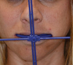 A stick bite is extremely useful for ensuring that a cant does not exist in the final restorations. In most cases, the horizontal line should be parallel to the interpupillary line.