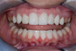 The patient wore the temporary restorations for 10 days. She was comfortable and experienced minimal breakage of the molar veneers. She approved the size and shapes but asked for a shade change to an OM3.