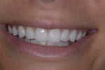 Full-smile and retracted postoperative views. The patient was pleased with the final restorations. Note the gingival condition as well as the way they fit her smile line despite the initial tooth size, which was 3 mm shorter.