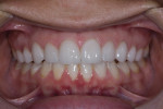 Full-smile and retracted postoperative views. The patient was pleased with the final restorations. Note the gingival condition as well as the way they fit her smile line despite the initial tooth size, which was 3 mm shorter.