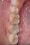 Preoperative appearance of teeth Nos. 30 and 31. Tooth No. 30 has a failing mesial-occlusal-lingual inlay and tooth No. 30 has a failing disto-occlusal resin.