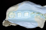 The final impression of teeth Nos. 30 and 31. Despite not using gingival retraction cord or paste prior to the impression, extension beyond the finish lines and into the sulcus can be seen. The impression colors are light green for the tray material and light blue for the wash material. The pastel colors of the Aquasil Ultra Cordless impression material are the result of high levels of titanium dioxide, intended to improve scanability.