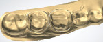 Scan of the final impression for teeth Nos. 30 and 31 using a 3Shape lab scanner (3Shape, www.3shapedental.com).