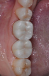 Final restorations on teeth Nos. 30 and 31 immediately after cementation with Calibra Universal Self Adhesive Resin Cement.