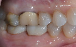 Buccal view of the final restoration on teeth Nos. 30 and 31. Note the slightly supragingival margins that allow for improved hygiene and good visualization for the dentist at recall visits.