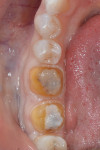 Completed preparations on teeth Nos. 30 and 31. Note that preparation margins were kept supragingival in most areas to aid in impression-making, cementation of the final crowns, and maintaining hygiene.