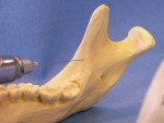Figure 1  Anterior positioning of the needle may achieve bony contact but not be close enough to the mandibular foramen to achieve predictable, profound anesthesia of the IAN.