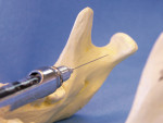Figure 2b  Demonstration of the Akinosi closed mouth technique. The needle is inserted at the level of the maxillary mucogingival junction, mesial to the mandibular ramus and with the needle bevel facing mesially. The needle is inserted about 25 mm i