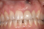 Figure 1 Initial presentation. Tooth # 9, the left maxillary central incisor, has a fistula due to a failing apicoectomy. Note the discolored gingival tissues.