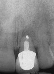 Figure 2 Radiograph of the failed apicoectomy. Truncated root and apical radiolucency are evident. The prognosis is hopeless.