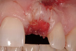 Figure 3 The tooth was extracted atraumatically. Following degranulation, freeze dried demineralized bone allograft was placed with a bovine collagen plug. The collagen helped contain the graft and served as a barrier membrane, as well as a hemostati