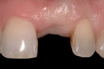 Figure 5 Healing 2 months following extraction. Note retention of papilla. Labial gingival contour has been preserved.