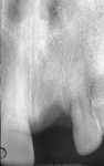 Figure 6 Radiograph at 2 months following extraction, the day of implant surgery. Bony healing appears to be proceeding nicely.