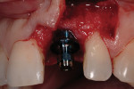 Figure 7a Labial view of the flap design and implant placement. Vertical incision was made 1 tooth distally on the interradicular bone at a right angle to the bone. The vertical incision connected horizontally at a right angle at the level of the gin