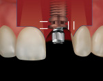 Figure 7b The incision design began 1 tooth mesial and distal to the implant site with a vertical incision that extended from the alveolar mucosa to the height of gingival contour. It extended intrasulcularly to the palatal line angles of both teeth