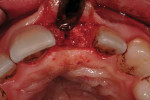 Figure 9a Implant exposure and second-stage surgery. Initial incision was made from palatal line angle to palatal line angle of the adjacent teeth. Note the volume of gingival tissue that is displaced labially, allowing for additional gingival augmen