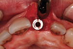 Figure 10 Occlusal view of implant at secondstage surgery after removal of the cover screw and bone profiling.