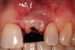 Figure 11 Suturing with gut during second-stage surgery after placement of the titanium temporary healing abutment. Gingiva is placed labially and coronally elevated over the temporary healing abutment to achieve even more gingival growth (e.g., a no