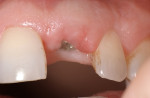 Figure 12 Two weeks post-exposure, the temporary healing abutment is almost completely covered by the gingiva. Additional gingival augmentation has been achieved labially and coronally.