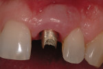Figure 13 A permanent abutment has been fabricated. Note the labial gingival profile. Augmentation makes it appear as if there is a root prominence.