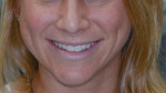 Composite was added to the incisal edge of the centrals. This creates a mock-up of the anticipated increase in size.