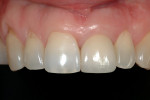 Figure 17 Final implant restoration of tooth #9. Restoration courtesy of Dr. Ira Novsam, Westport, CT.