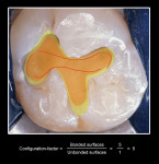 Figure 2 In an occlusal cavity preparation, the ratio between the free and bonded restoration surfaces (C-factor) is high, creating shrinkage stresses that are higher than the bond strength.