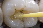 Figure 6 A self-etch primer was applied to the dentin for 20 seconds and air-dried for 2 seconds.
