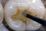 Figure 7 A bonding agent was applied to the enamel and dentin surfaces for 20 seconds, lightly air-dried and light-cured.