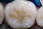 Figure 9 The internal dentin core was developed with successive increments following the anatomical morphological contours.