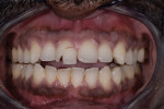 Pretreatment frontal retracted view showing vertical and horizontal fractures of tooth No. 8.