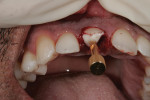 A post handle was used to remove the luxated tooth No. 8.