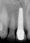 Digital periapical view, case complete.