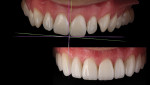 Recognizing a pre-existing cant in work-ups is important for initiating treatment to correct the violation. Analyzing teeth without the face is accomplished by first ensuring that the inter-incisal angle is accurately represented, not understated orinadvertently corrected with photographic techniques, which facilitates laboratory communication for correcting the canted smile. Smile design restorations fabricated with IPS e.max® and IPS® Empress (Ivoclar Vivadent, www.ivoclarvivadent.com).